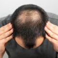 Дерматологи рассказали о 8 недооцененных методах лечения, которые на самом деле предотвращают выпадение волос